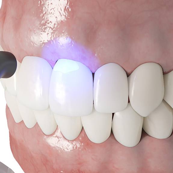 Illustration of cosmetic dental bonding in Grand Prairie, TX